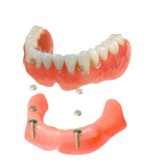磁石式アタッチメント・部分入れ歯の構造