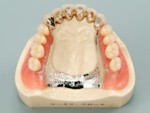 アタッチメントの入れ歯・精密義歯